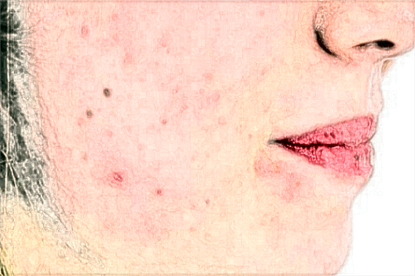 漳州175醫(yī)院祛斑好不好?2024漳州175醫(yī)院激光祛斑價(jià)格