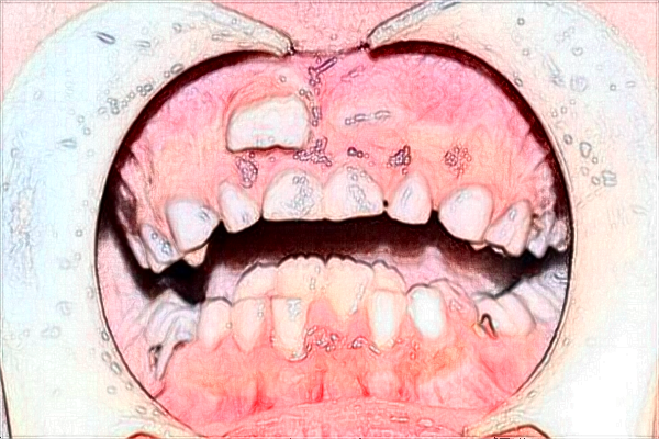 漳州175醫(yī)院牙科拔牙好不好?拔牙后的注意事項(xiàng)