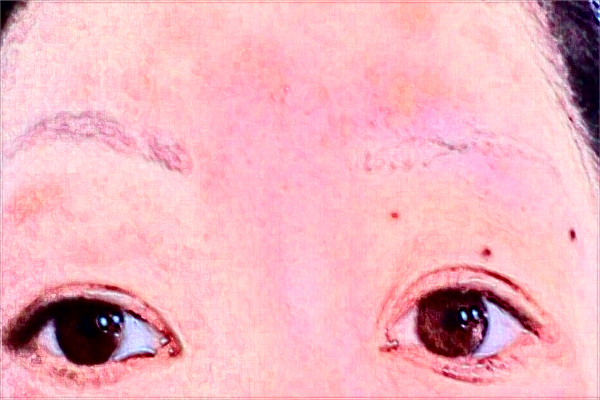 廈門市第一醫(yī)院光子嫩膚收費價格怎么樣?光子嫩膚好不好?