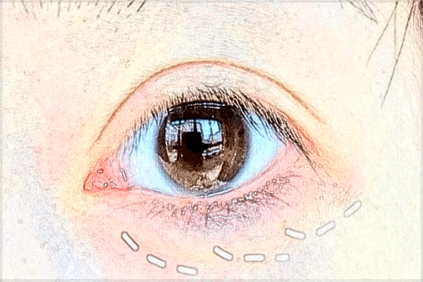 廈門市第一醫(yī)院去眼袋怎么樣?2024去眼袋收費價格