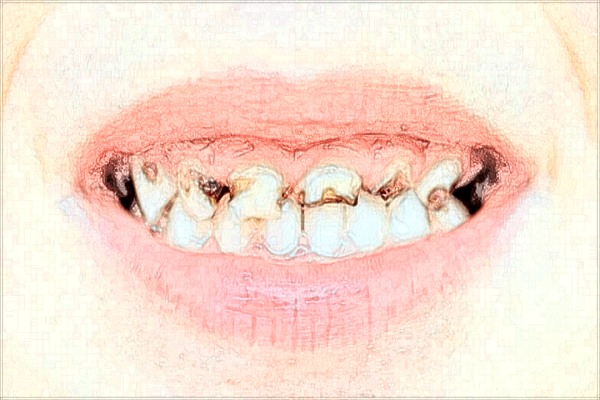 廈門市第—醫(yī)院牙科種植牙找哪個醫(yī)生?2024收費價格