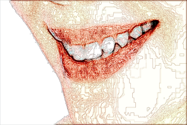 河北省口腔醫(yī)院全瓷貼面怎么樣_全瓷貼面對牙齒傷害大嗎