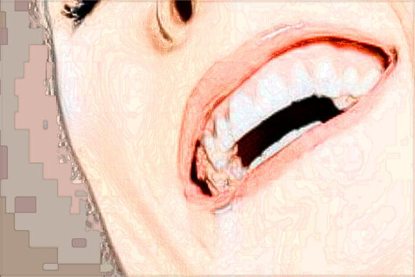 北京大學(xué)人民醫(yī)院種牙多少錢_做的怎么樣