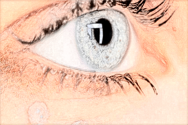 河科大二附院去眼袋技術(shù)怎么樣?2024去眼袋手術(shù)價(jià)格