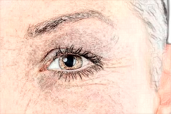 浙江省中醫(yī)院激光去黑眼圈好嗎?去黑眼圈會不會反彈