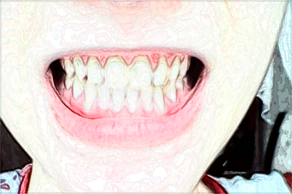 北大口腔醫(yī)院鑲滿口牙多少錢_鑲滿口牙需要把牙都拔掉嗎