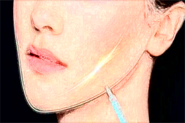 廣州華美全臉脂肪填充怎么樣_醫(yī)生技術(shù)好不好