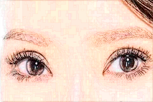 2024廣州華美去眼袋手術一般多少錢【去眼袋案例】