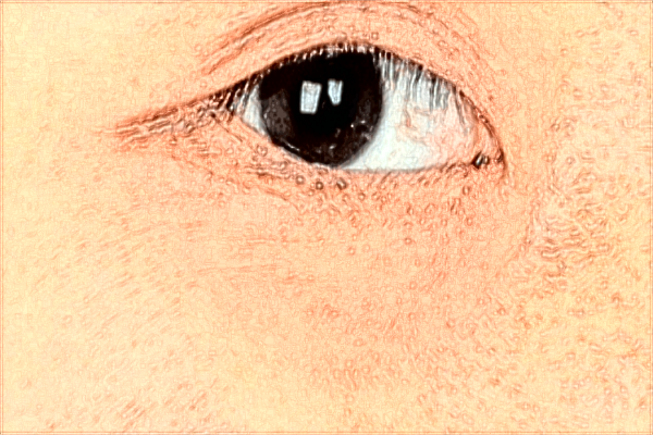 南昌大學(xué)第一附屬醫(yī)院去痘印好嗎?2024激光祛痘印價(jià)格