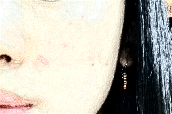 南昌大學(xué)第一附屬醫(yī)院去痘印好嗎?2024激光祛痘印價(jià)格