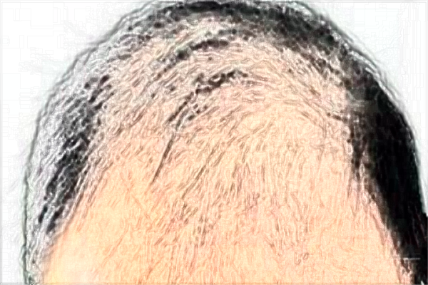 南昌大學(xué)第一附屬醫(yī)院種植頭發(fā)怎么樣?2024植發(fā)價(jià)格