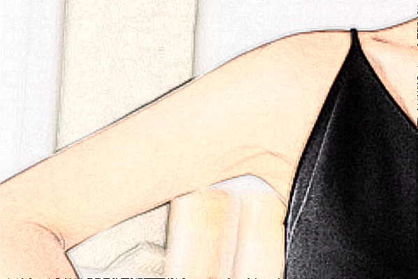 河北省人民醫(yī)院激光脫毛做的好嗎【激光脫毛案例分享】