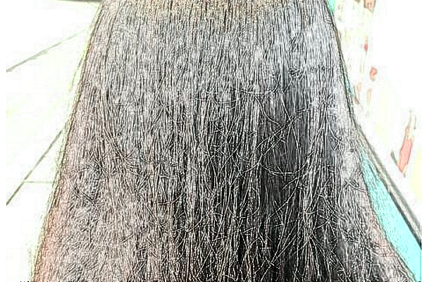 無錫市第二人民醫(yī)院植發(fā)做的怎么樣_案例+價(jià)格