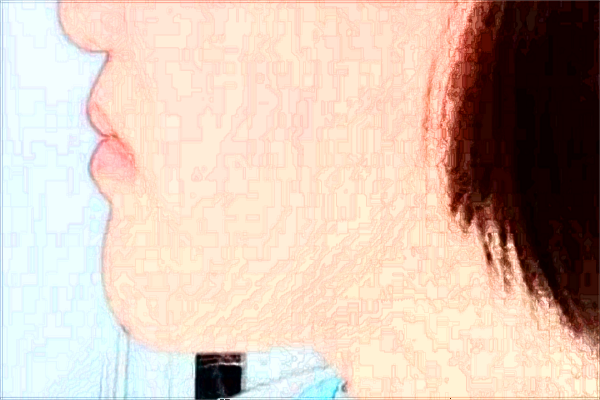 2024寧波市第一醫(yī)院去疤怎么樣_案例+價格