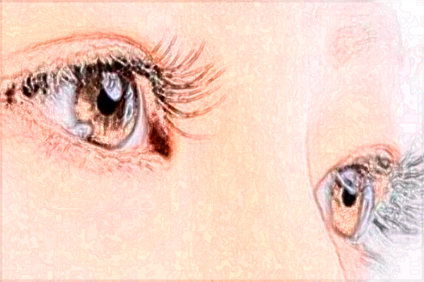 2024四川華西醫(yī)院割雙眼皮價格多少_做的怎么樣