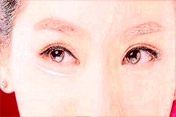 六安市人民醫(yī)院激光去除眼袋有沒有作用_做的怎么樣