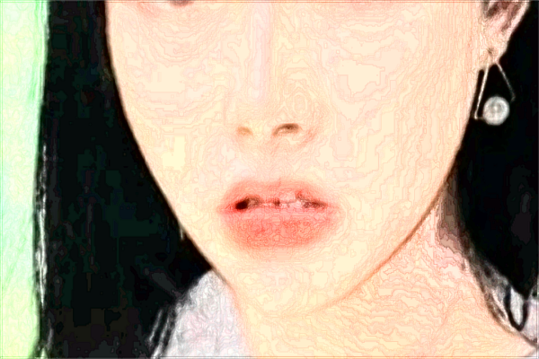 浙江省中醫(yī)院脂肪填充做的好嗎_案例+價格