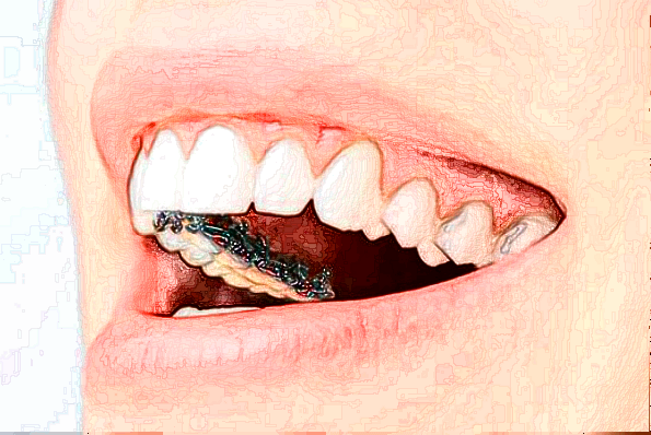 浙江省中醫(yī)院補(bǔ)牙做的好嗎_案例+價(jià)格