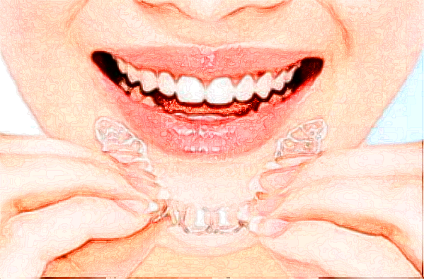 2024江蘇省口腔醫(yī)院瓷貼面怎么樣_案例+價格