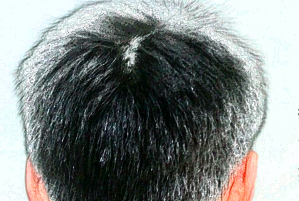 上海東方醫(yī)院植發(fā)做的好嗎_案例+價(jià)格