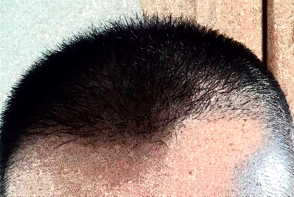 上海東方醫(yī)院植發(fā)做的好嗎_案例+價(jià)格