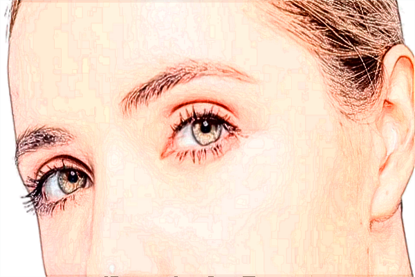 2024保定市第一中心醫(yī)院去眼袋多少錢_案例+價格分享