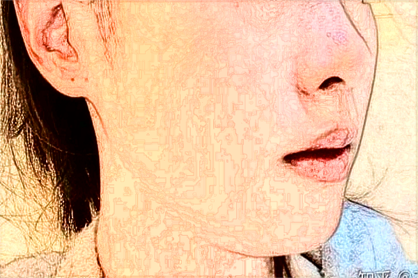 大連醫(yī)科大學(xué)附屬第一醫(yī)院激光去紅血絲做的好嗎_案例價格分享