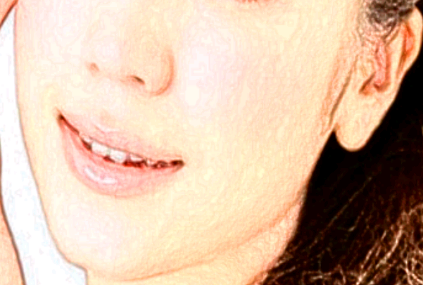 保定市第一中心醫(yī)院激光祛斑價目表(價格表)怎么樣