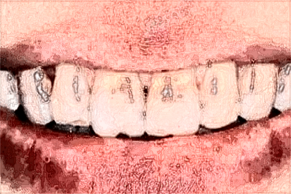 南寧市第二人民醫(yī)院牙科貴嗎?2024矯正牙齒多少錢(qián)