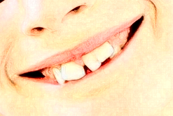 2024重慶醫(yī)科大學附屬口腔醫(yī)院做的全瓷冠怎么樣【全瓷冠案例】