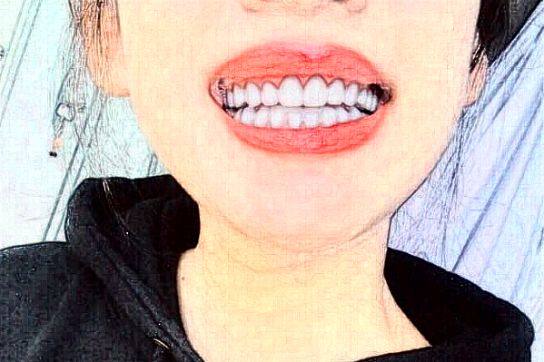 重慶醫(yī)科大學附屬口腔醫(yī)院全瓷牙怎么樣_哪個醫(yī)生比較有名氣