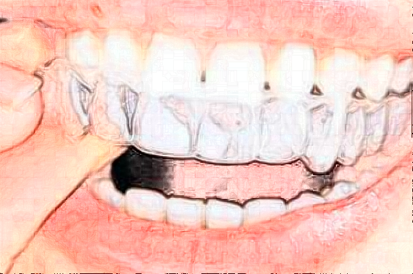 	 重慶醫(yī)科大學附屬口腔醫(yī)院隱形牙套矯正手術(shù)做的好嗎_誰做的比較好