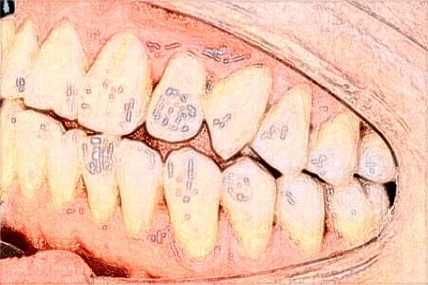 昆明市第—人民醫(yī)院補牙好不好?2024補牙貴嗎?
