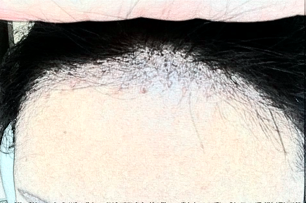 　　發(fā)際線不好看、大量脫發(fā)導(dǎo)致禿頂?shù)那闆r等，會(huì)給朋友們帶來(lái)很大的煩惱，這種情況可以選擇植發(fā)手術(shù)來(lái)，大連醫(yī)科大學(xué)附屬第一醫(yī)院做植發(fā)的技術(shù)比較不錯(cuò)，根據(jù)大連地區(qū)網(wǎng)絡(luò)檢索的結(jié)果，比較常見(jiàn)的是發(fā)際線價(jià)格一般會(huì)在1100-38000元左右不等，比較常見(jiàn)的頭頂加密植發(fā)價(jià)格一般會(huì)在900-9300元左右不等，以上給出的價(jià)格僅供于參考，具體詳細(xì)的價(jià)格還需要到醫(yī)院找醫(yī)生進(jìn)行面診之后來(lái)獲取。  　　1、2024大連醫(yī)科大學(xué)附屬第一醫(yī)院植發(fā)案例  　　很多年前自己一直脫頭發(fā)，其實(shí)這也屬于正常的反應(yīng)，因?yàn)轭^發(fā)都會(huì)有一個(gè)新陳代謝，隨著時(shí)間的增加，自己的頭發(fā)脫的有點(diǎn)多，每一次洗頭發(fā)的時(shí)候都掉一大把，當(dāng)時(shí)也沒(méi)有太在意，一次無(wú)意間發(fā)現(xiàn)了自己頭頂?shù)念^發(fā)有一些稀少，這才意識(shí)到了脫發(fā)的嚴(yán)重性，所以想通過(guò)植發(fā)手術(shù)來(lái)，在家人的陪同下來(lái)到了大連醫(yī)科大學(xué)附屬第一醫(yī)院，跟醫(yī)生說(shuō)明了自己掉發(fā)的情況，并且問(wèn)了醫(yī)生能不能做植發(fā)手術(shù)，醫(yī)生采取診斷之后建議說(shuō)可以做植發(fā)手術(shù)，所以配合了醫(yī)生的工作，整體手術(shù)操作大概用了不到三個(gè)小時(shí)左右的時(shí)間，術(shù)后就能夠看到一些植發(fā)的痕跡，在半個(gè)月之后直的頭發(fā)慢慢的長(zhǎng)了出來(lái)，看到長(zhǎng)出來(lái)的頭發(fā)自己的心情也愉悅了很多，終于不用擔(dān)心頭發(fā)稀少的問(wèn)題帶來(lái)的困擾了。  　　2、2024大連醫(yī)科大學(xué)附屬第一醫(yī)院簡(jiǎn)介  　　大連醫(yī)科大學(xué)附屬第一醫(yī)院整形美容科是一個(gè)集醫(yī)療、教學(xué)、科研、預(yù)防為一體的大型綜合性醫(yī)院，醫(yī)院包括有美容外科、整形外科、頜面美容外科、皮膚激光美容外科等，醫(yī)院開展的手術(shù)項(xiàng)目有先天性和創(chuàng)傷性的畸形修復(fù)、除皺、乳房整形、減肥、面部年輕化抗衰老、植發(fā)、手術(shù)、手術(shù)等多個(gè)項(xiàng)目，醫(yī)院多年的發(fā)展結(jié)合了先進(jìn)的技術(shù)和設(shè)備儀器，建立了一個(gè)重大特色的項(xiàng)目合作單位，并定期會(huì)派專業(yè)的醫(yī)護(hù)人員進(jìn)行整形美容技術(shù)學(xué)術(shù)交流和研討，為廣大女性朋友在求美的道路上制定個(gè)性化的醫(yī)美服務(wù)，醫(yī)院內(nèi)的醫(yī)生都有著先手的操作手法，組建了一支技術(shù)精湛的醫(yī)生團(tuán)隊(duì)，會(huì)為女性朋友在秋美的道路上所需求，進(jìn)行個(gè)性化的設(shè)計(jì)和診斷，得到了很多朋友們的一致好評(píng)。