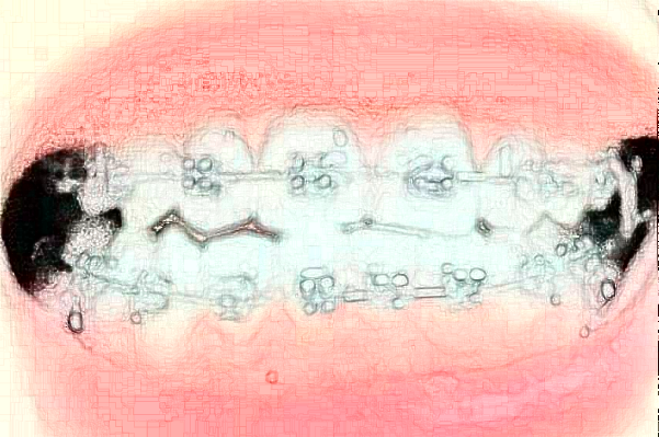 合肥市第二人民醫(yī)院全瓷牙價(jià)格多少?全瓷牙案例分享