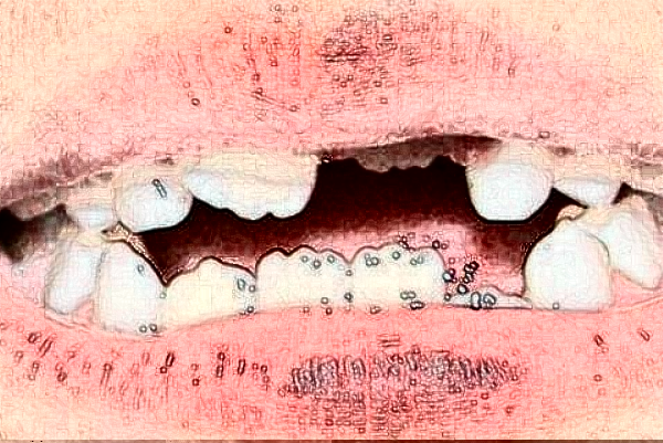 河北醫(yī)科大學(xué)口腔醫(yī)院牙齒修復(fù)價格多少?牙齒修復(fù)案例分享