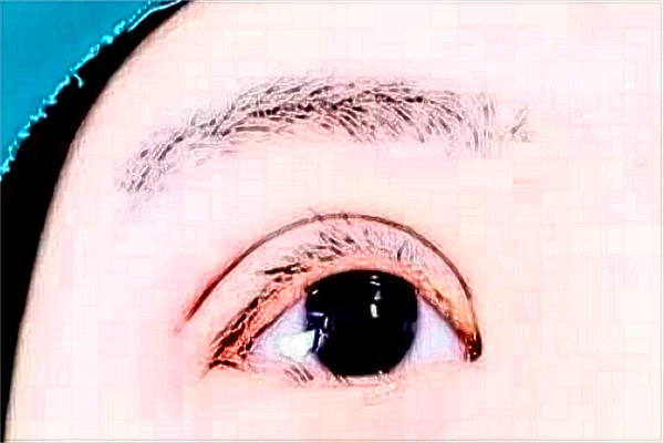 上海切開(kāi)雙眼皮做的好不好_哪家醫(yī)院做的比較好