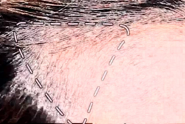 2024阜陽市人民醫(yī)院植發(fā)際線做的好嗎_需要多少錢