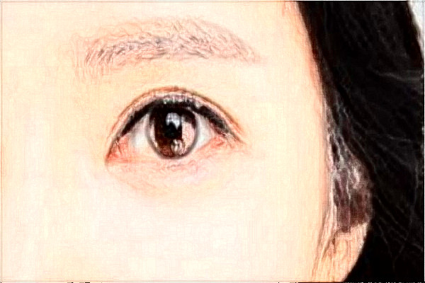 2024金華市中心醫(yī)院激光近視誰做的好?激光近視手術的后遺癥有哪些