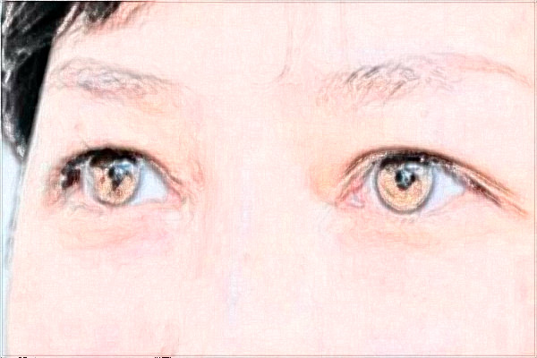 2024金華市中心醫(yī)院激光近視誰做的好?激光近視手術的后遺癥有哪些