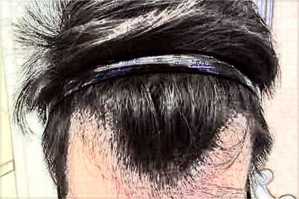 2024金華市中心醫(yī)院植發(fā)做的好嗎_案例+價格