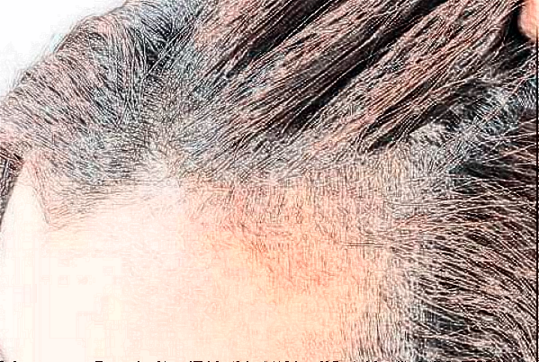 2024金華市中心醫(yī)院植發(fā)做的好嗎_案例+價格