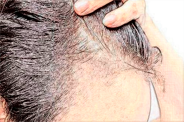 2024中山大學(xué)附屬第一醫(yī)院植發(fā)怎么樣?植發(fā)是怎么植的