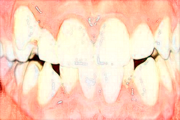 中山大學(xué)附屬第一醫(yī)院隱適美好嗎?2024隱適美價(jià)格多少
