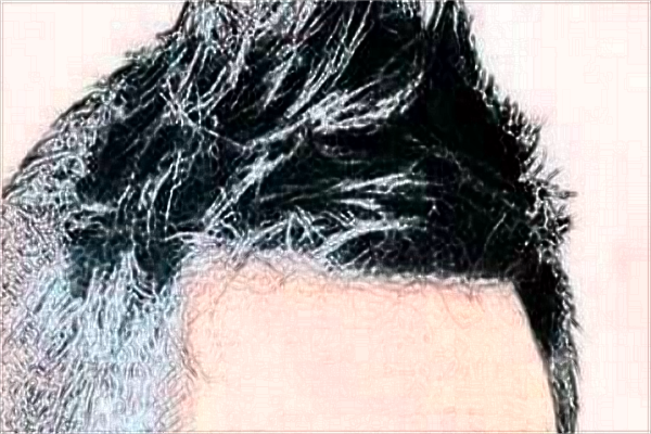 中山大學(xué)附屬第一醫(yī)院植發(fā)選哪個(gè)科?植發(fā)的危害和后遺癥