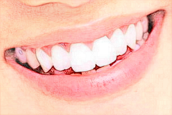 中山大學附屬口腔醫(yī)院種牙怎么樣?種牙和鑲牙的區(qū)別