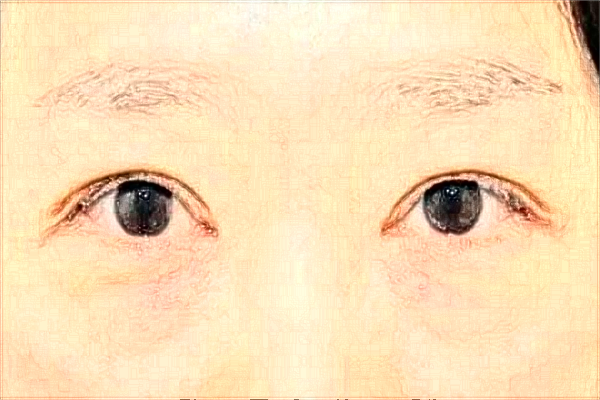 2024徐州市中心醫(yī)院激光消除黑眼圈做的好嗎？體驗案例分享