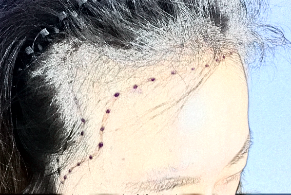 2024臺州醫(yī)院植發(fā)怎么樣_哪位醫(yī)生技術(shù)比較不錯