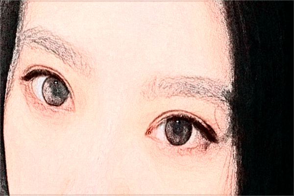 阜陽市人民醫(yī)院近視激光手術(shù)需要多少錢【案例分享】