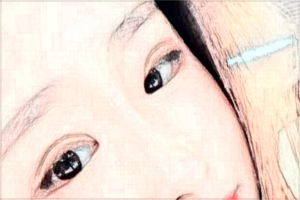 蘇州第四人民醫(yī)院激光去紅血絲多少費(fèi)用？醫(yī)生排名